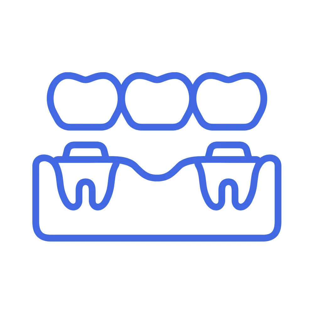 dental bridge
