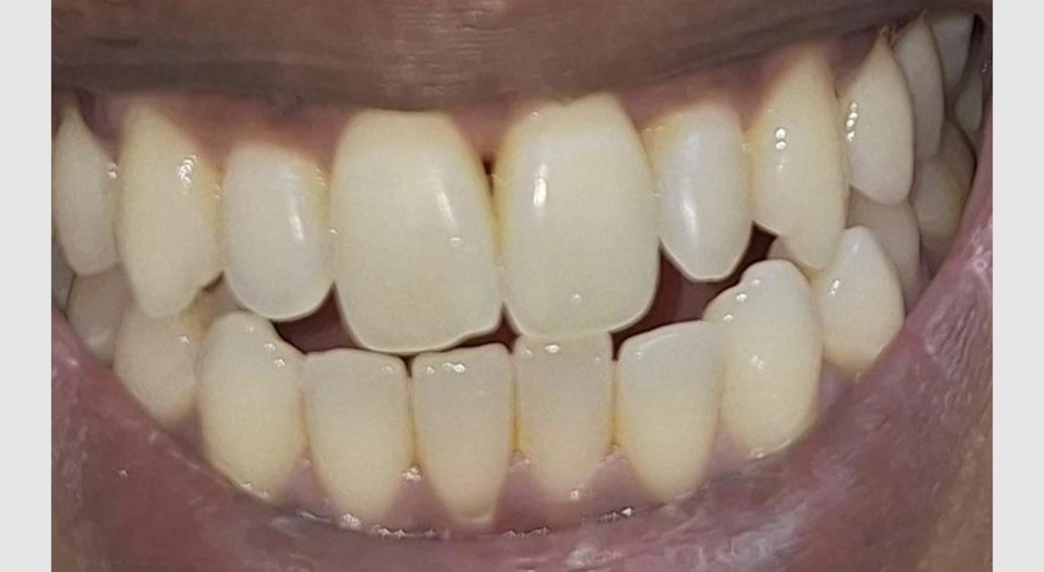 Dev before clear aligner treatment
