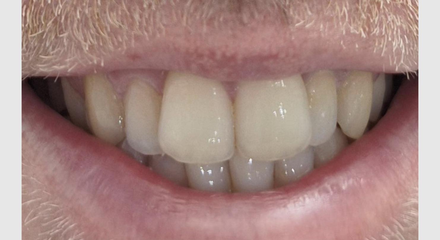 Ethan before clear aligner treatment