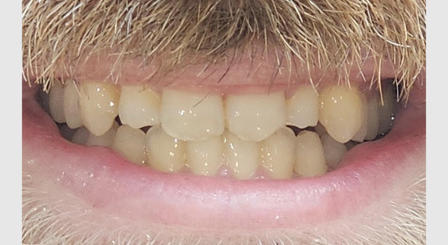Jamie after clear aligner treatment