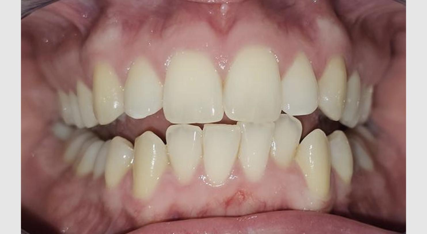 Nicole before clear aligner treatment