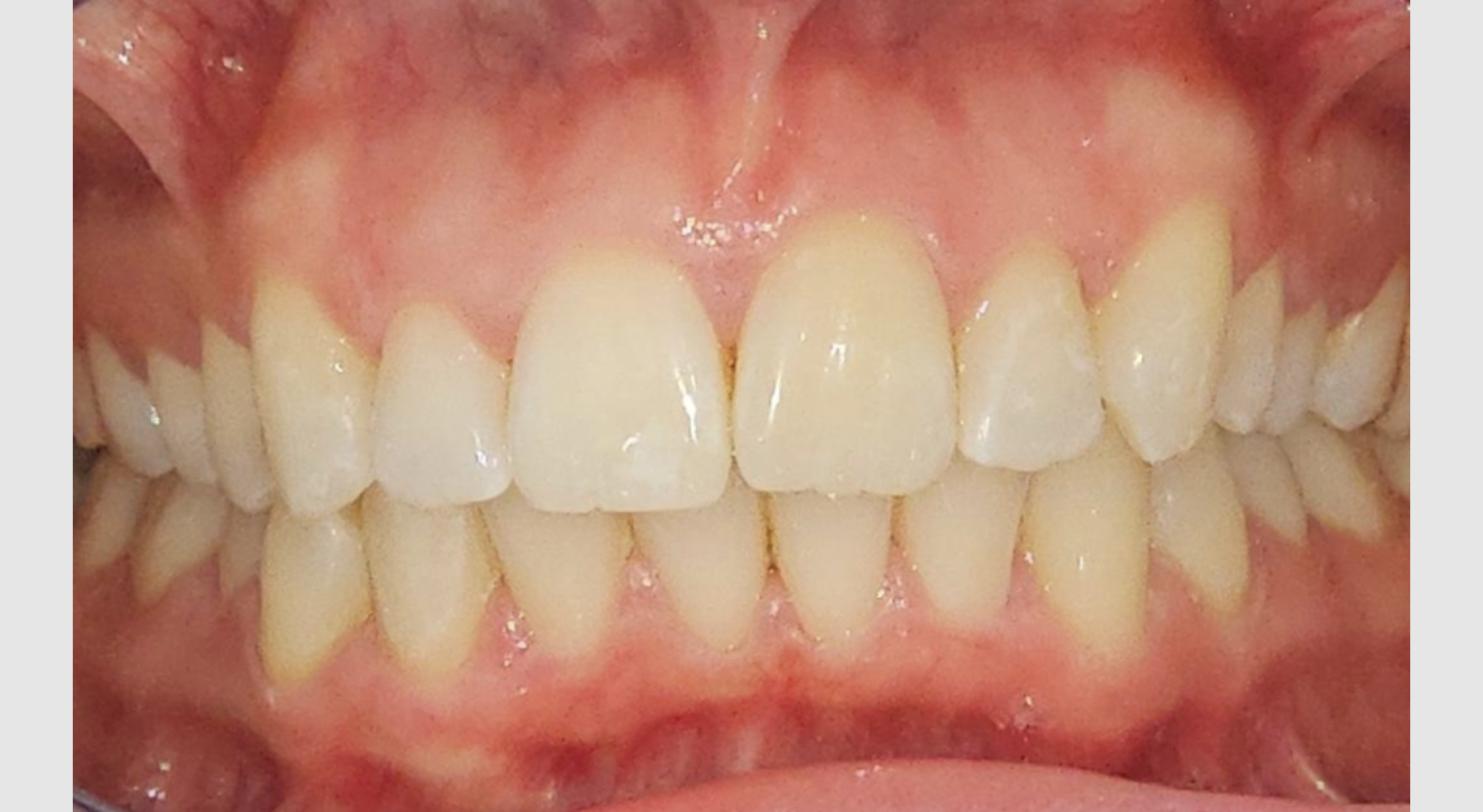 Sophie before clear aligner treatment